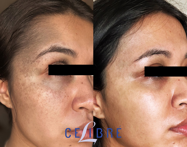 Before and after results showing significant fading of Nevus of Ota with laser therapy.