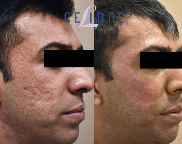 Acne Scar Removal with CO2 Laser Treatment - Before & After 