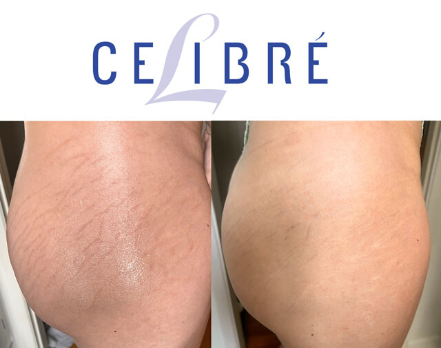 Permanent makeup removal before and after results at Celibre Medical Torrance using advanced laser treatment to safely fade unwanted cosmetic tattoo pigment.