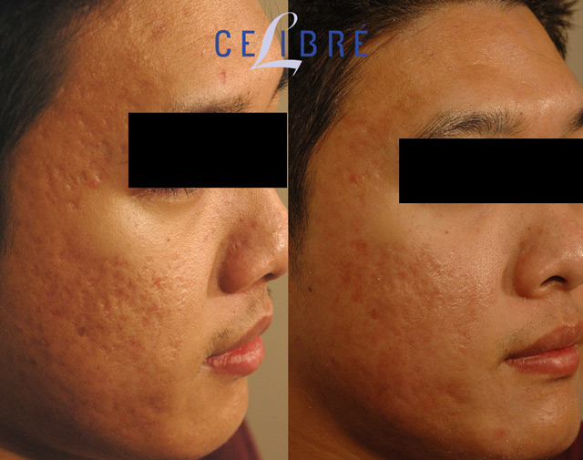 Profractional-laser-resurfacing-for-acne-scars