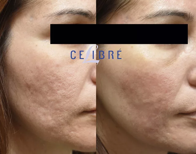 Acne Scar Removal Before and After Pictures of Actual Patients