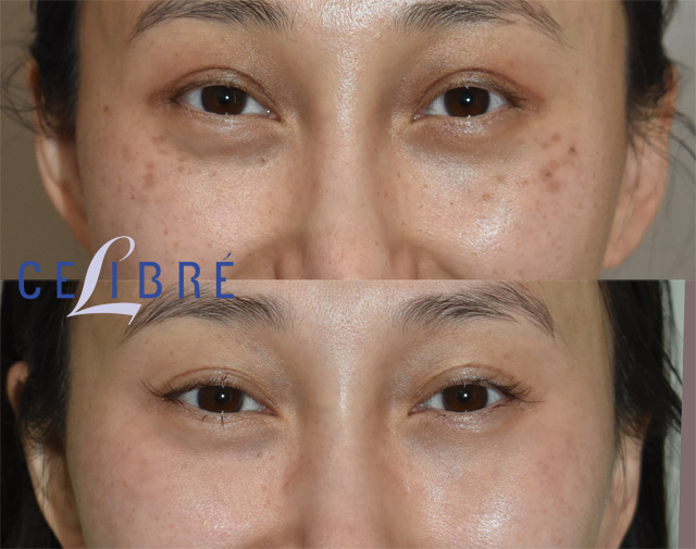 Before and after results of abnom nevus of ota birthmark removal using modern laser technology treatment