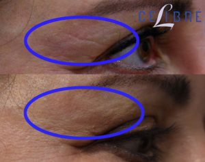 16 - eyelid wrinkles with CO2 laser resurfacing