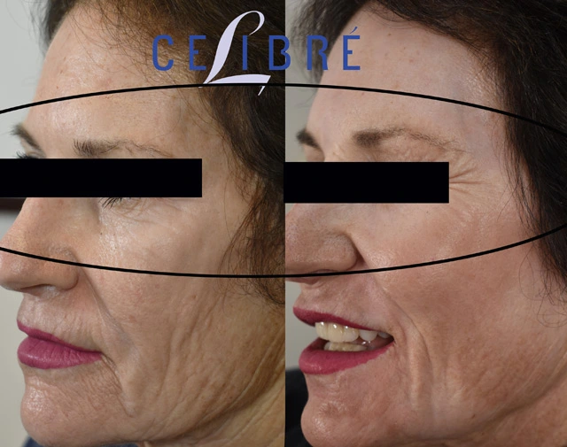 Smooth out the eye wrinkles before after photos shows smoother skin, softened lines, brighter eyes, refreshed appearance, renewed confidence naturally.