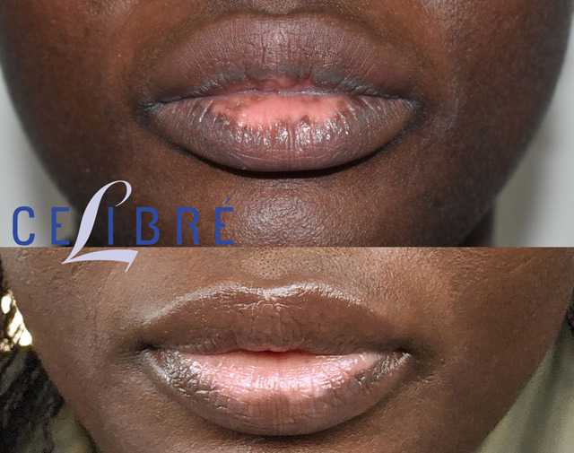 Laser Lip Spot Removal in Los Angeles. This treatment targets dark spots on the lips to reveal a smoother, more even look.