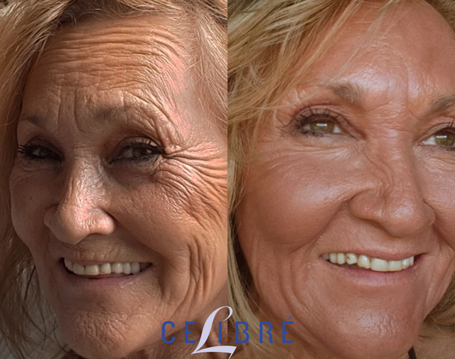 Laser Resurfacing Before and After Pictures of Actual Patients