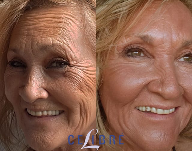 Fractional Laser Resurfacing