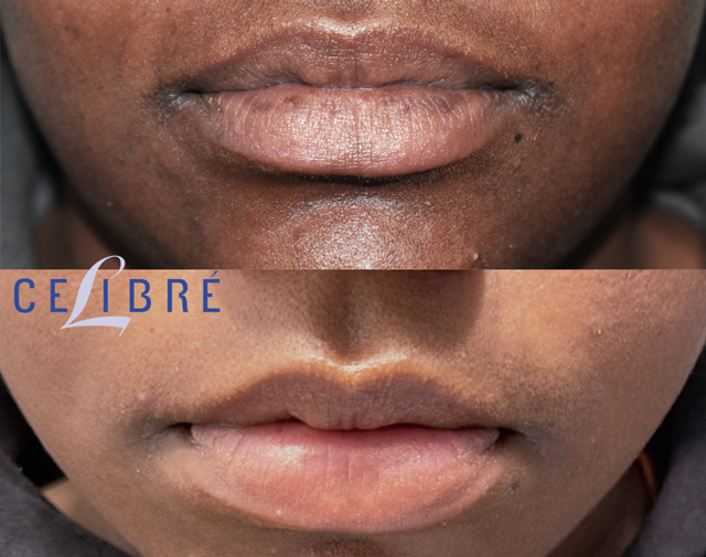 Laser lip spot removal before and after photos showing visible improvement in lip pigmentation and tone.