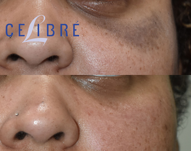 Nevus of Ota laser removal treatment showing gradual skin tone improvement, reducing pigmentation safely and effectively with modern dermatological technology.
