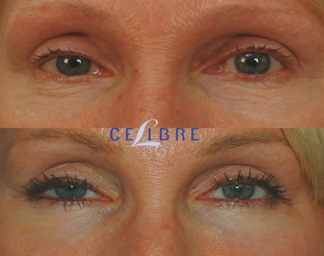 Smoother eye wrinkles without Botox using retinol, hydration, sunscreen, facial massage, sleep, collagen support, and gentle daily skincare.