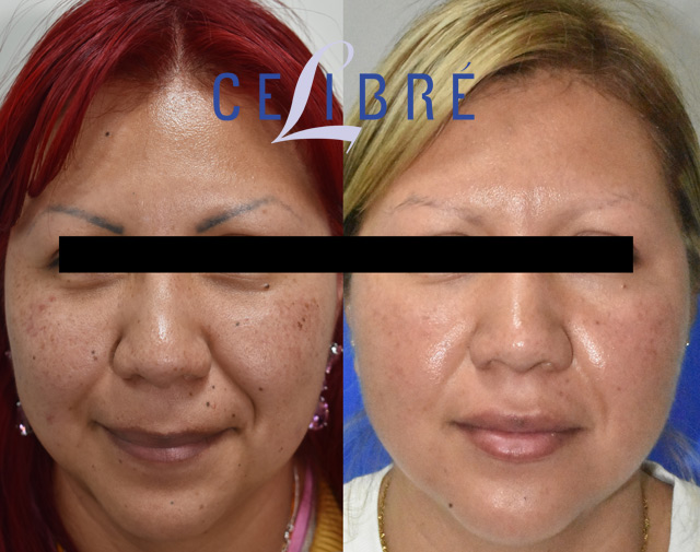 Eyebrow Permanent Makeup Removal Professional treatment to safely fade unwanted brow pigment and restore a more natural-looking appearance.