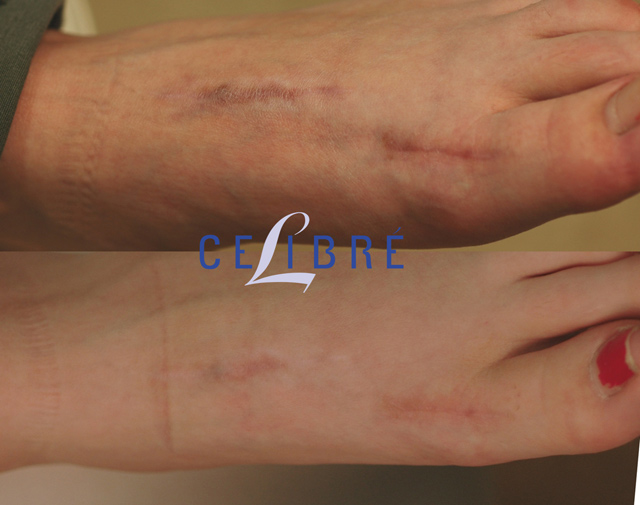 Scar Removal Before and After Pictures
