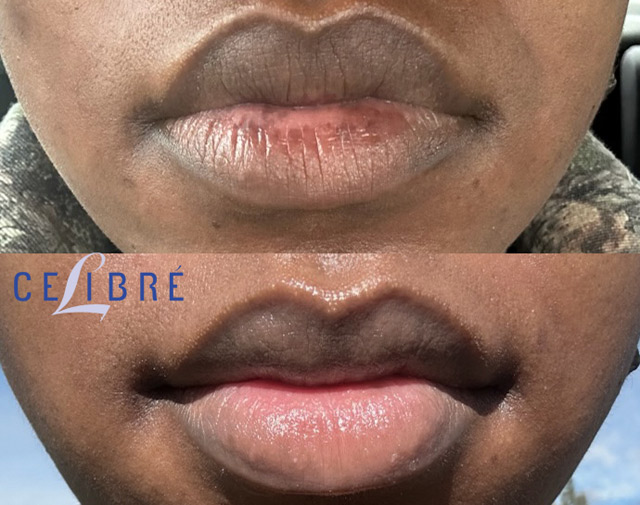 Palomar laser for lip spot removal before and after photos highlighting safe, effective, and noticeable results.