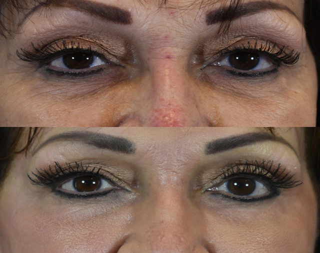 Before and after for laser under eye wrinkles reveals smoother skin, softened lines, brighter eyes, refreshed appearance, youthful confidence naturally.