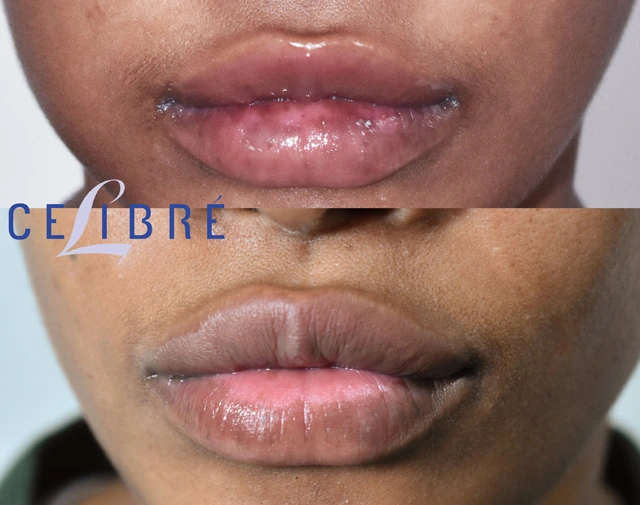 Laser Lip Spot Removal Before and After Photos – Real Treatment Results & Visible Transformation