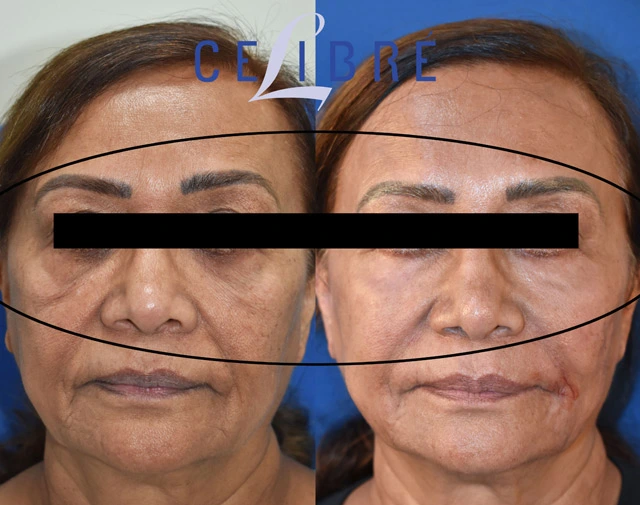 Effective ways to reduce under-eye wrinkles include hydration, retinol, sunscreen, sleep, treatments, and healthy skincare habits for smoother younger-looking skin.