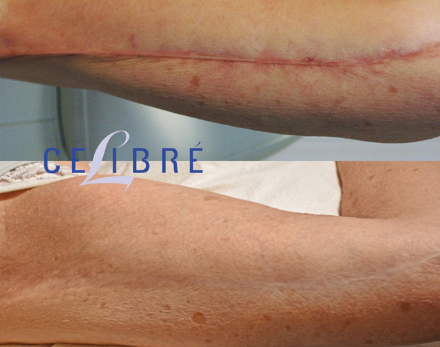 Laser Treatment of Scars