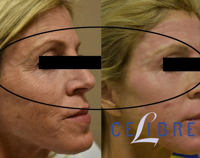 Eliminate fine lines under the eyes with laser before and after shows smoother skin, reduced wrinkles, brighter eyes, refreshed appearance.