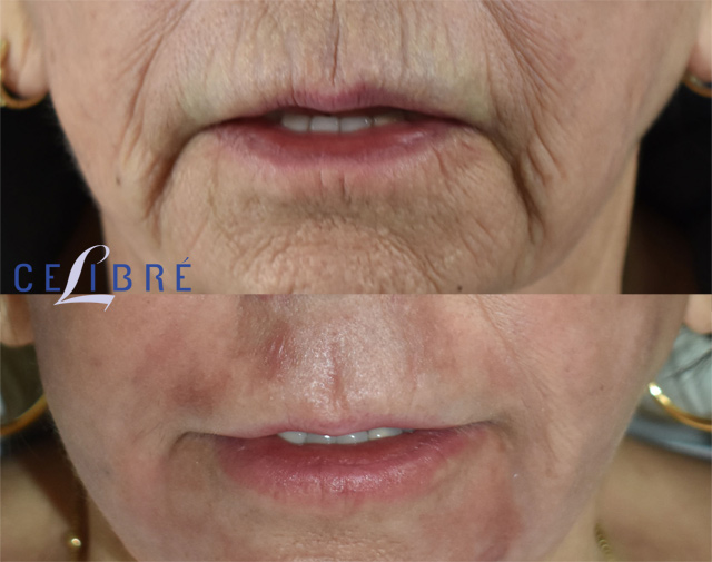 Erase fine lines with get-rid-of-smokers-lines-with-laser-before-after results