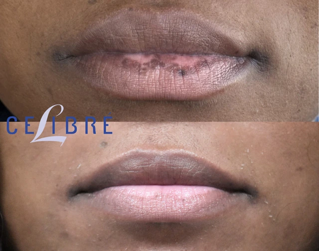 Smoking lip spots removed for smoother, healthier-looking lips. Real before and after results showing visible improvement and renewed confidence.