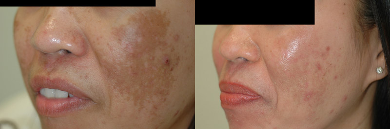 Melasma Before After