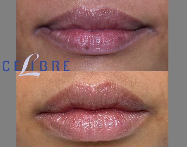 Asian lip spot removal with laser before and after results, showing the improvement in dark lip pigmentation and a smoother, more even lip tone after professional laser treatment.