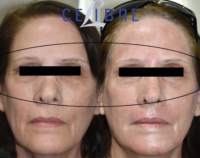 Erase under eye wrinkles without PRP and botox using retinol, hydration, sunscreen, facial massage, sleep, collagen support, and gentle skincare.