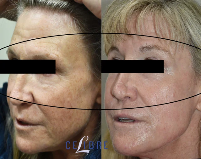 Sun damage and wrinkles treatment for under eyes includes retinol, sunscreen, hydration, laser options, sleep, skincare habits for smoother skin.