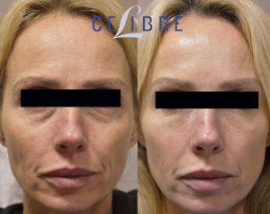 Botox Before And After Pictures: Real Results From Real Patients