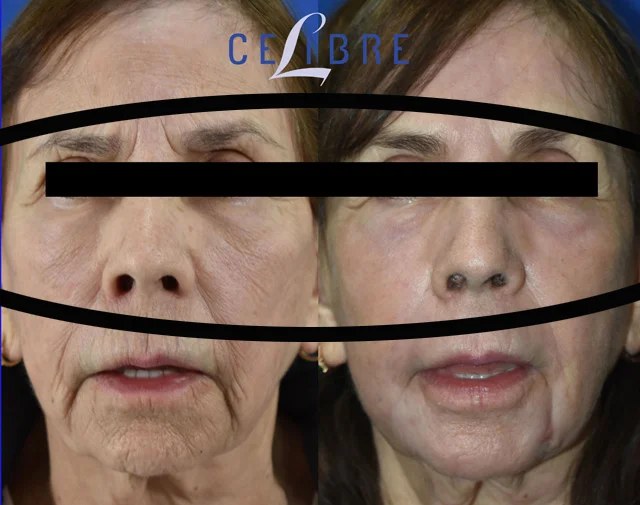 Best option to remove under eye wrinkles includes retinol, hydration, sunscreen, laser treatments, sleep, skincare for smoother skin and confidence.