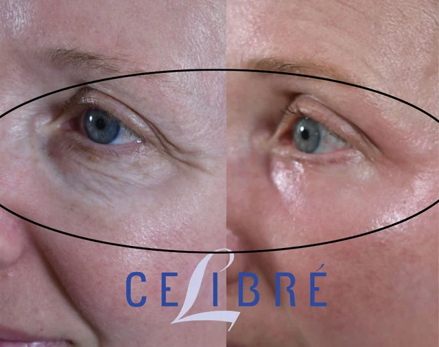Crinkly lines under the eyes before after laser shows smoother skin, softened wrinkles, brighter eyes, refreshed appearance, renewed confidence naturally.