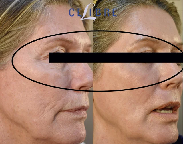 Under eye rejuvenation for wrinkles before after pictures shows smoother skin, softened lines, brighter eyes, refreshed appearance, youthful confidence naturally.