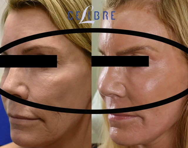 Fix fine lines under the eyes with Sciton laser before after reveals smoother skin, softer wrinkles, brighter eyes, refreshed appearance.