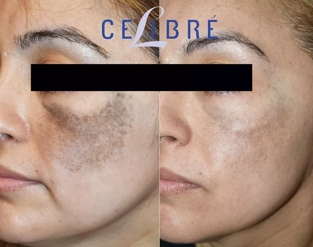 Birthmark Removal Before And After Pictures