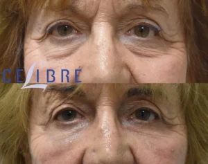 How Long Does Restylane Last