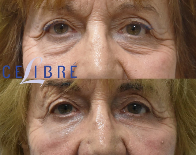 Restylane injections for under eye wrinkles helping smooth fine lines, refresh tired eyes, and improve skin appearance.