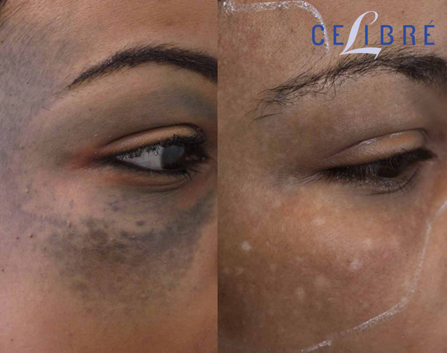 Transforming confidence with precision: African-American-laser-birthmark-removal achieves smooth, even skin results.