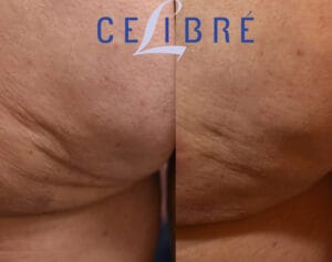 Cellulite Treatment