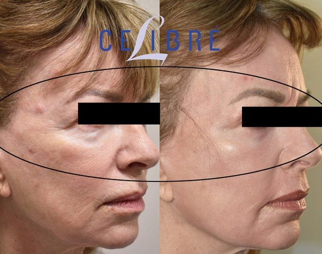 Reduce crow’s feet naturally with retinol, hydration, sunscreen, facial massage, healthy sleep habits, collagen support, and consistent gentle skincare routines.