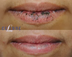 brown spots on lips