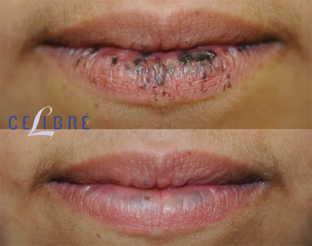 Lips Spots Removal Dark And Sun Spots On Lips   3 Laser For Lip Spots Before After Jpg.webp