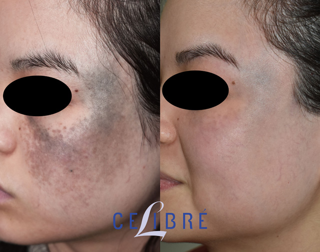 Before and after results of Nevus of Ota birthmark removal using laser treatment, showing clearer, even-toned skin and effective pigmentation reduction.