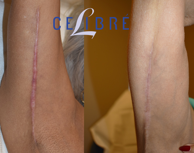 Scar Removal Before and After Pictures