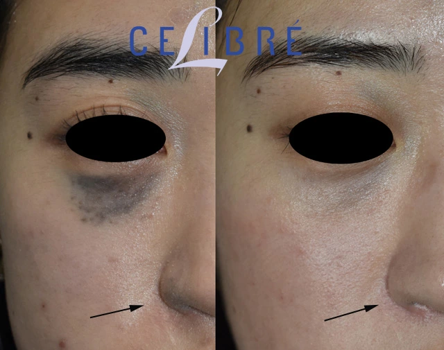 Before and after photos of laser removal for a nevus of Ota birthmark demonstrate significant pigment reduction, improved skin clarity, and natural-looking results achieved with advanced laser treatment.