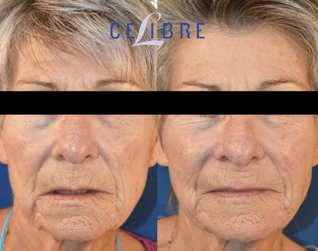 Witness the incredible before-and-after of Sculptra, restoring lost volume for a more youthful, natural-looking appearance.