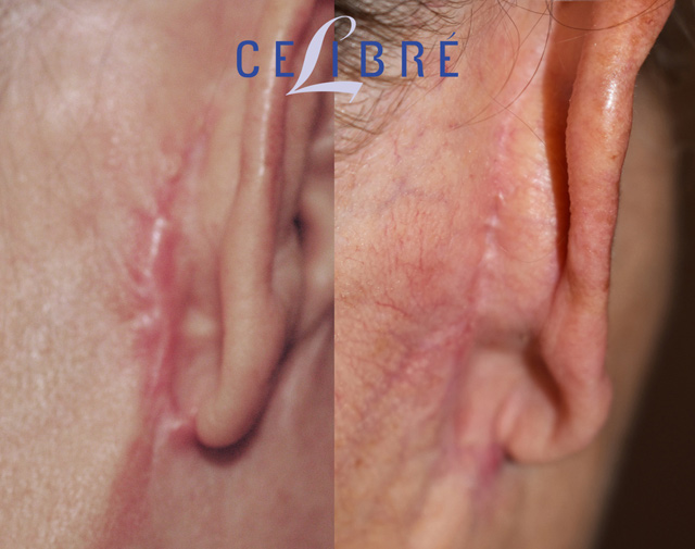cholesteatoma surgery scar