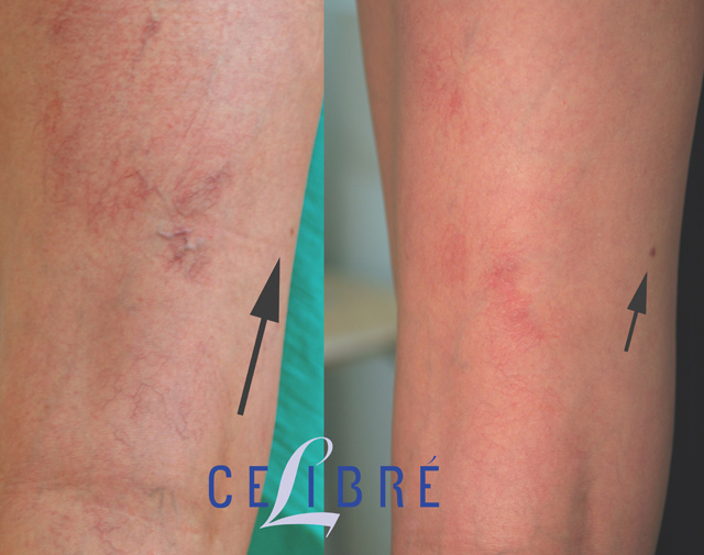 sclerotherapy near me uk