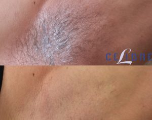 4 - permanent underarm hair removal with laser