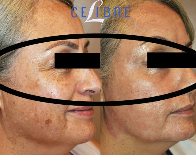 Remove crow’s feet with laser before after reveals smoother skin, reduced wrinkles, brighter eyes, youthful appearance, refreshed confidence over time.