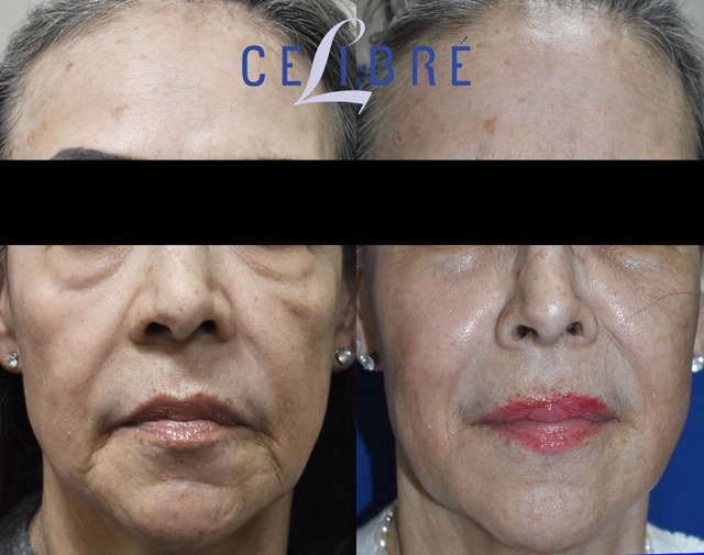 Cheeks and Lower Face Transformation with Sculptra – Before & After